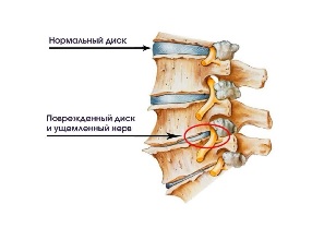 სიმპტომები, კისრის ოსტეოქონდროზის