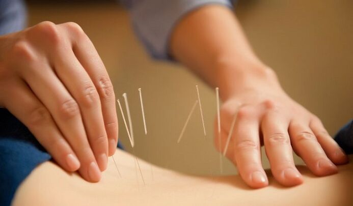 acupuncture წელის ტკივილის სამკურნალოდ